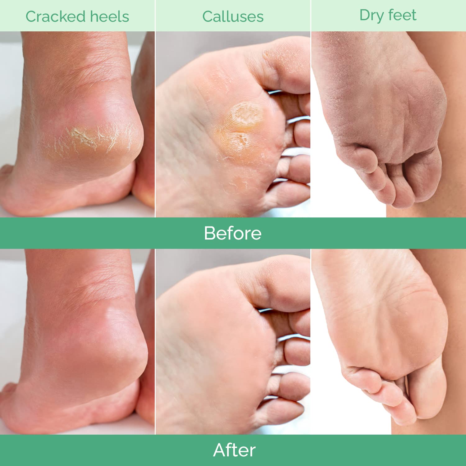 Plantifique Cosmety Paris Exfoliating Foot Peeling Mask for Soft Baby Feet - 2 Pairs - Removes Calluses, Dead and Dry Skin - Repairs Rough Heels In 7 Days; for Men and Women; Natural Gel Socks Booties